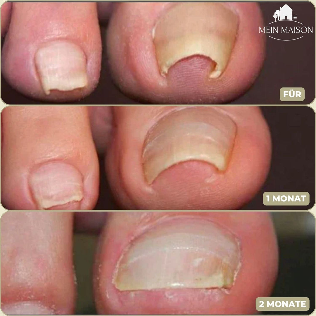 10+10 GRATUIT | FixaNail - Réparation instantanée des ongles
